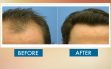 before-and-after-hair-transplat-sydney-hair-clinic-image35