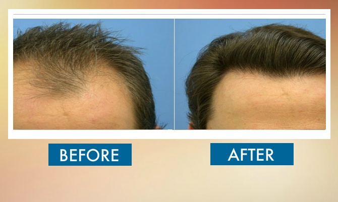before-and-after-hair-transplat-sydney-hair-clinic-image35
