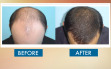 before-and-after-hair-transplat-sydney-hair-clinic-image36