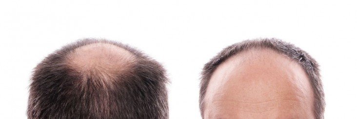 heriditary-hair-loss-male-pattern-baldness