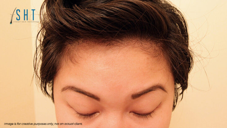 Eyebrow Hair Transplant FAQs